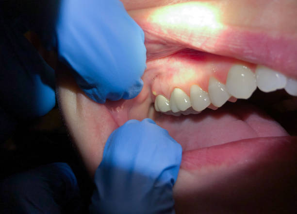 Best Emergency Wisdom Tooth Extraction in Roseto, PA